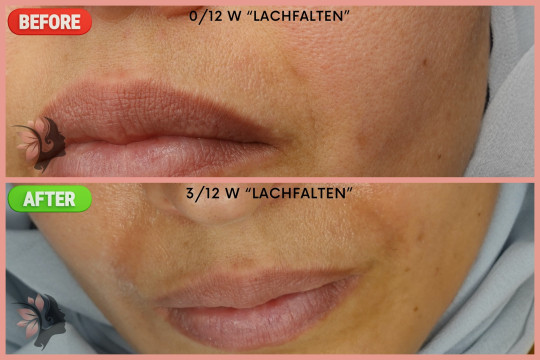 Plasma Pen - Bild 1 von 3